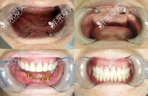太原众植齿科医院半口全口过程图