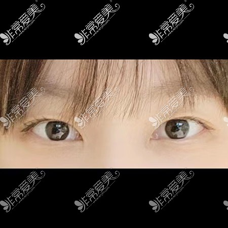 韩国icon整形医院双眼皮手术照片