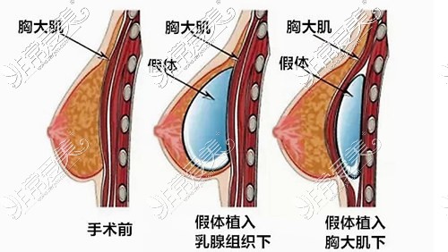 假体丰胸示意图