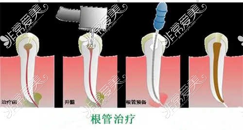 广州根管治疗哪家医院好