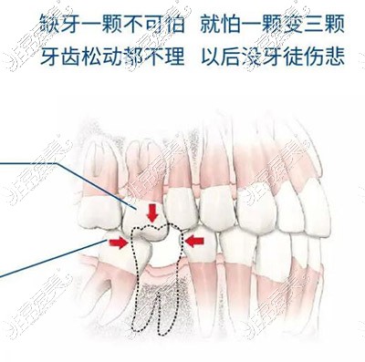 上海装全口假牙的价格多少?分享做义齿,全口植牙各费用详情