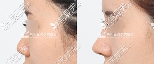 韩国美迪莹肋骨鼻修复前后对比