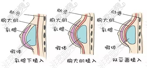 雙平面假體豐胸示意圖