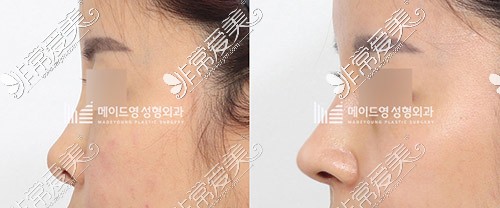 韩国美迪莹肋骨鼻修复照片