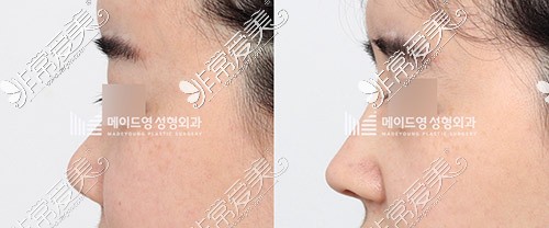韩国美迪莹肋骨鼻修复照片
