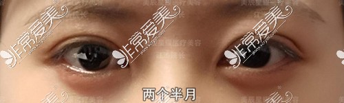 成都江涛医生做双眼皮修复术后两个半月