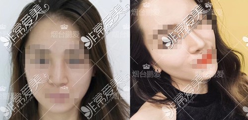 烟台哪里做假体隆鼻好?膨体、硅胶、自体骨大家都选这几家!