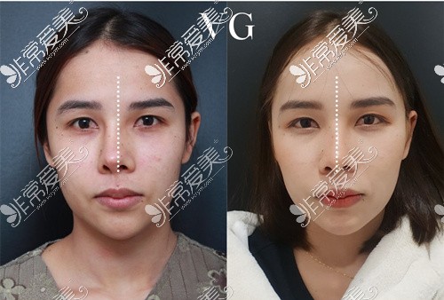 韩国VG百利酷整形医院歪鼻矫正前后对比