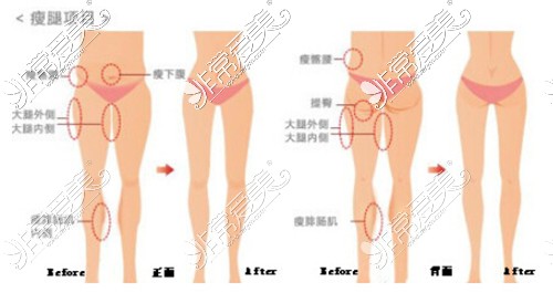 金华腿部吸脂比较好的医院有哪些？大腿吸脂多少钱