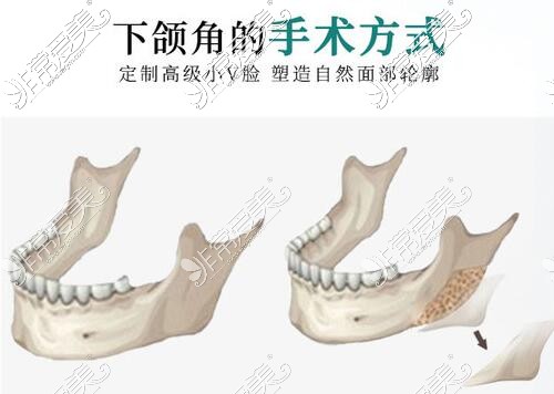 郑州下颌角磨骨价格要多少，花三万能做下颌磨骨吗？