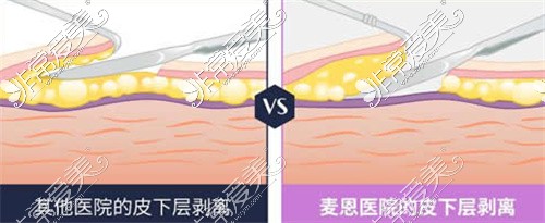 韩国麦恩整形外科皮下剥离方法