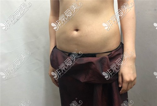 韩国梦线整形外科腰腹吸脂术前图
