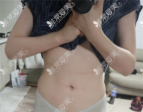 韩国梦线整形外科腰腹吸脂3个月效果
