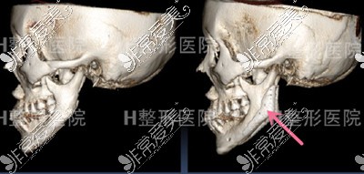 韩国白汀桓整形外科补骨前后对比图