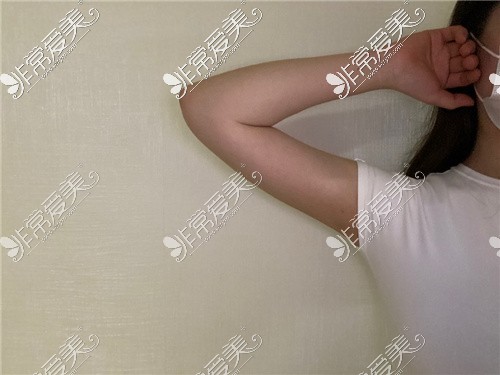 韩国Dreamline(梦线)整形外科手臂环吸+肩胛骨吸脂3个月手臂线条流畅