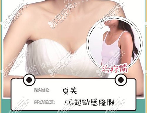 北京美莱5G动感隆胸图片