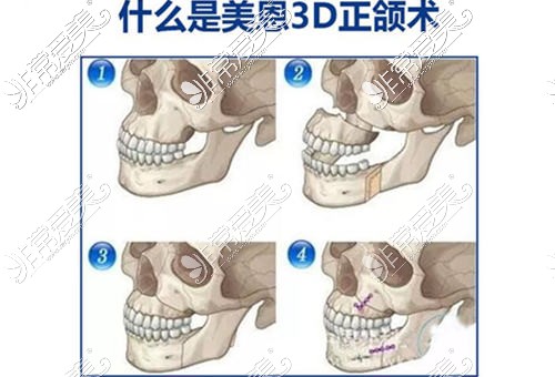 广州正颌凸嘴比较好的医院是哪家?分享广州正颌手术医院