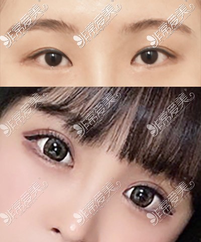 韩国icon双眼皮手术对比图