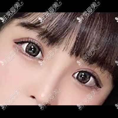 韩国icon埋线双眼皮照片
