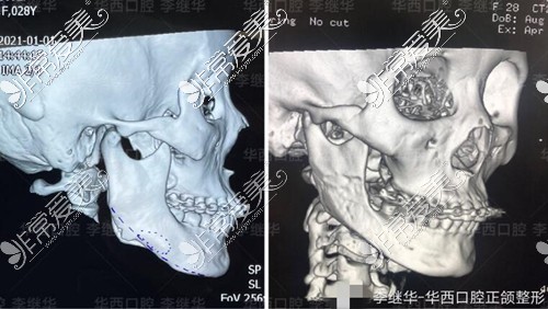 下颌角失败修复前后侧面对比图