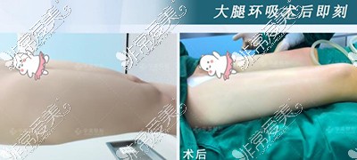 怀化华美大腿吸脂照片