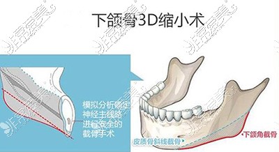 下颌骨3D缩小手术卡通图
