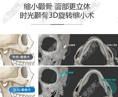 3D颧骨缩小磨骨优势