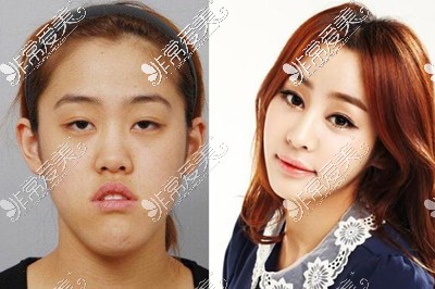 韩国ID整形医院双鄂手术对比照片