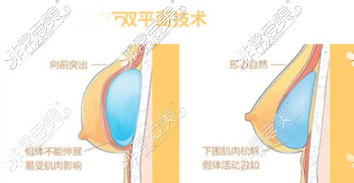 假體隆胸示意圖