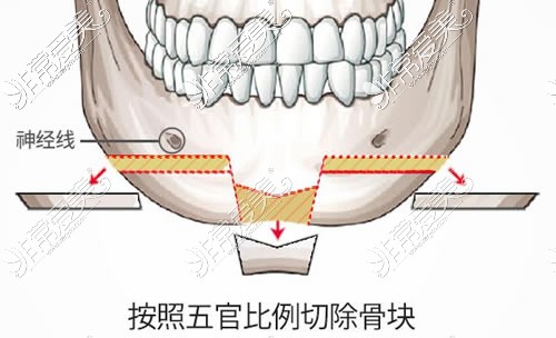 下巴截骨手術(shù)方式示意圖