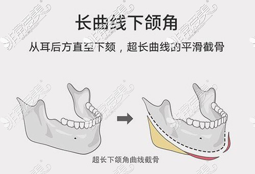 上海哪个医院做下颌角性价比高,看各院价格表及优势就明白!