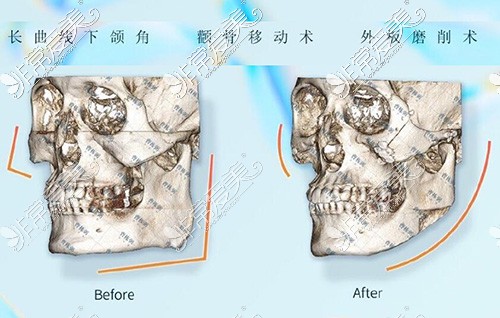 下颌角磨骨对比CT图