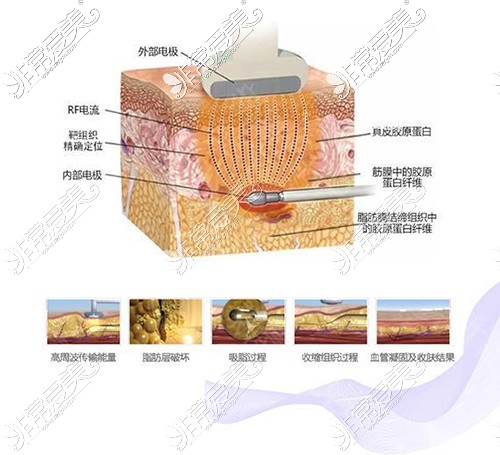 大连全身吸脂手术多少钱?哪家正规医院抽脂技术好价格便宜