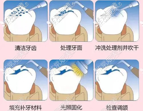 南京补牙多少钱一颗?哪个医院好?口碑牙科补牙收费标准公开