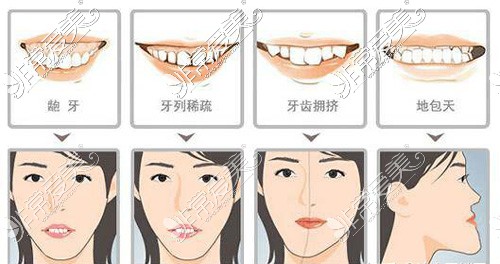 牙齿矫正适应人群