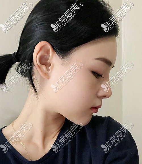 韩国优雅人肋骨隆鼻手术照片
