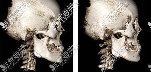 下颌角手术截骨示意图