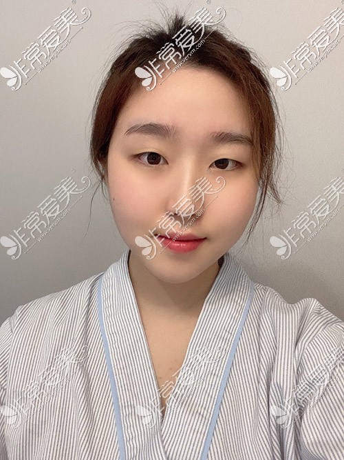 韩国优雅人隆鼻术前照片