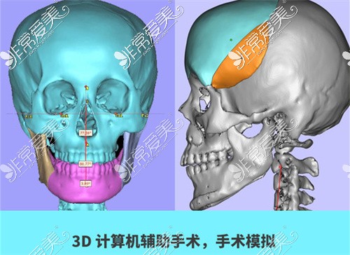 上海时光整形外科医院手术模拟<span style=