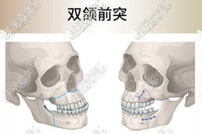 双鄂改善卡通示意图