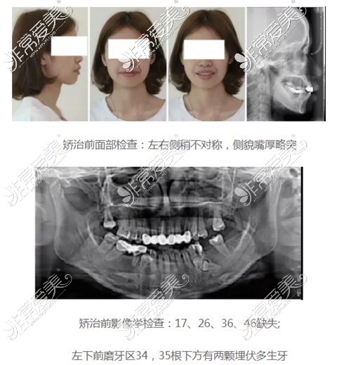 暨南大学附属穗华口腔正畸前后