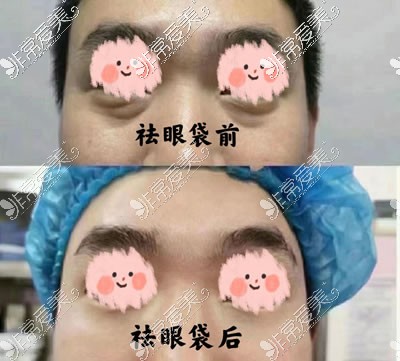 常州去眼袋口碑好的医院排行,前3家真人实例与详细价格曝光