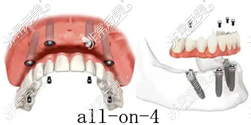 ALL-ON-4种植牙