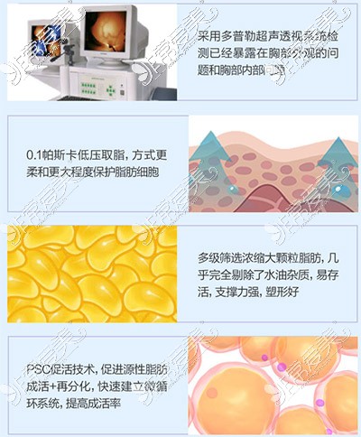 北京圣嘉新整形自体脂肪丰胸手术方法图