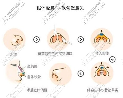 鼻综合整形照片