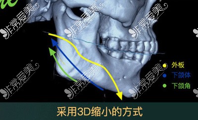 杭州哪里可以削骨?这几家可以做削骨技术口碑技术还不错!