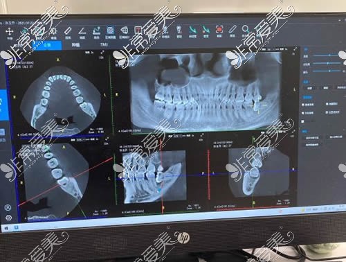 北京诺美口腔牙齿CT图片拍摄