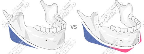 长曲线下颌角手术优势分析