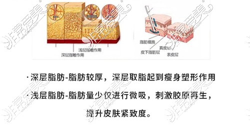 分层取脂避免凹凸不平