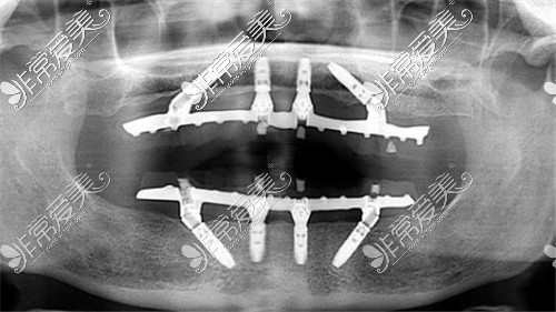 全口all-on-4种植